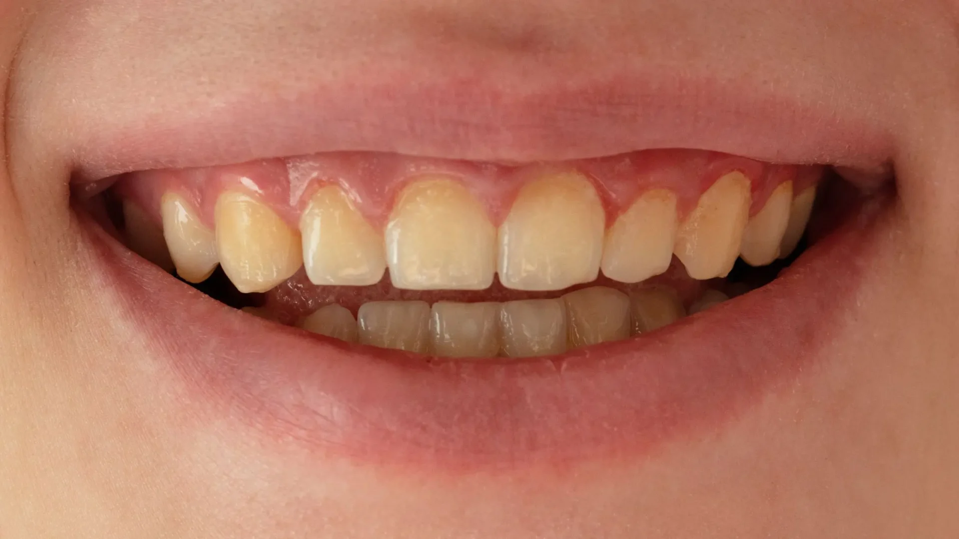 Sonrisa con dientes amarillos