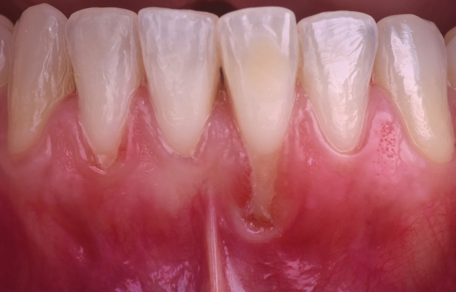 recesión gingival