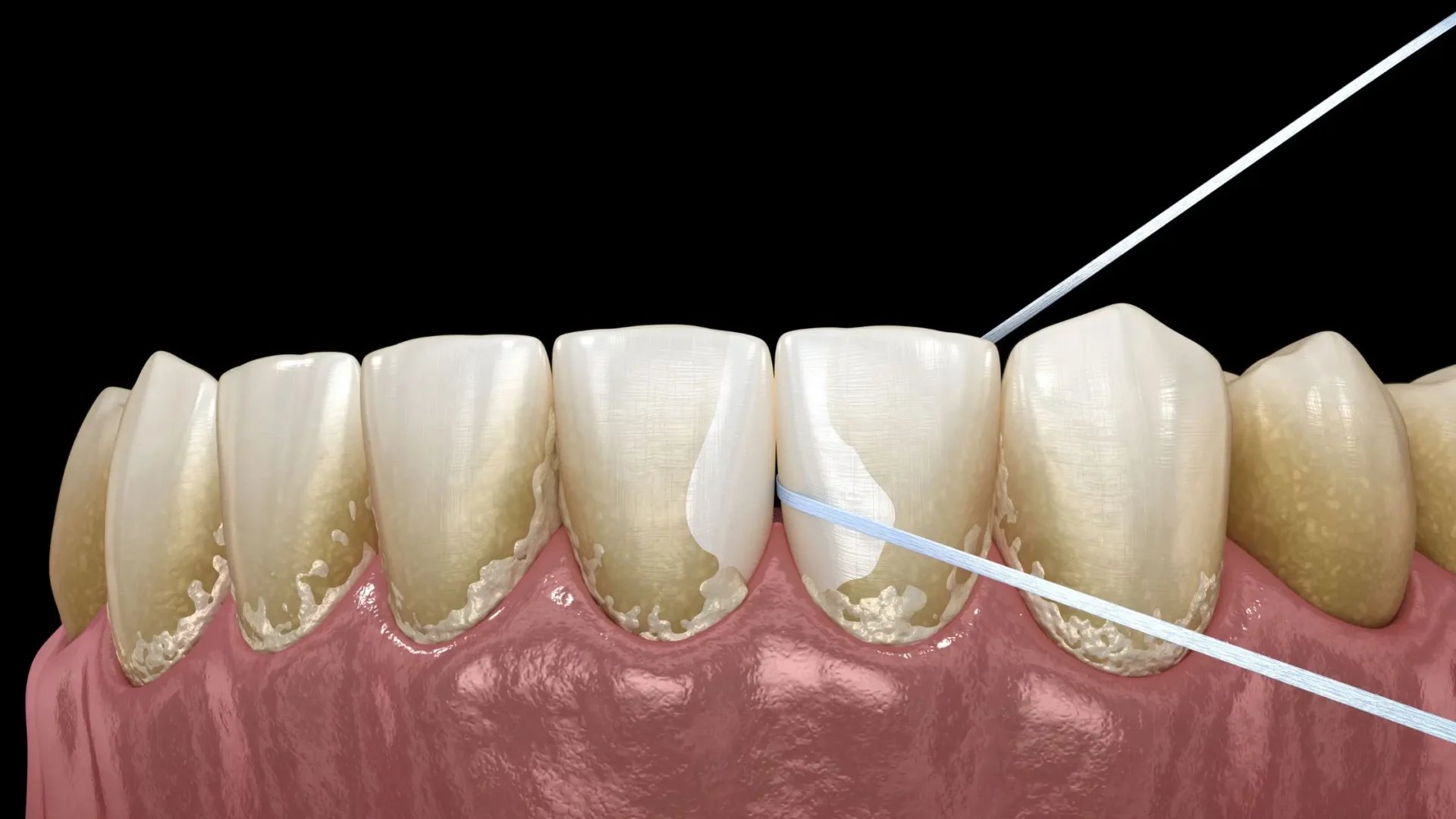 Imagen 3d de una dentaduca con sarro dental y placa bacteriana limpíandose con un hilo dental