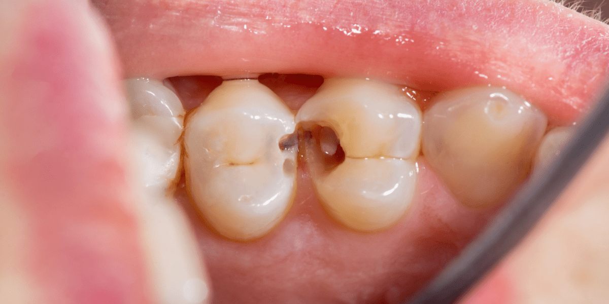 caries dentales