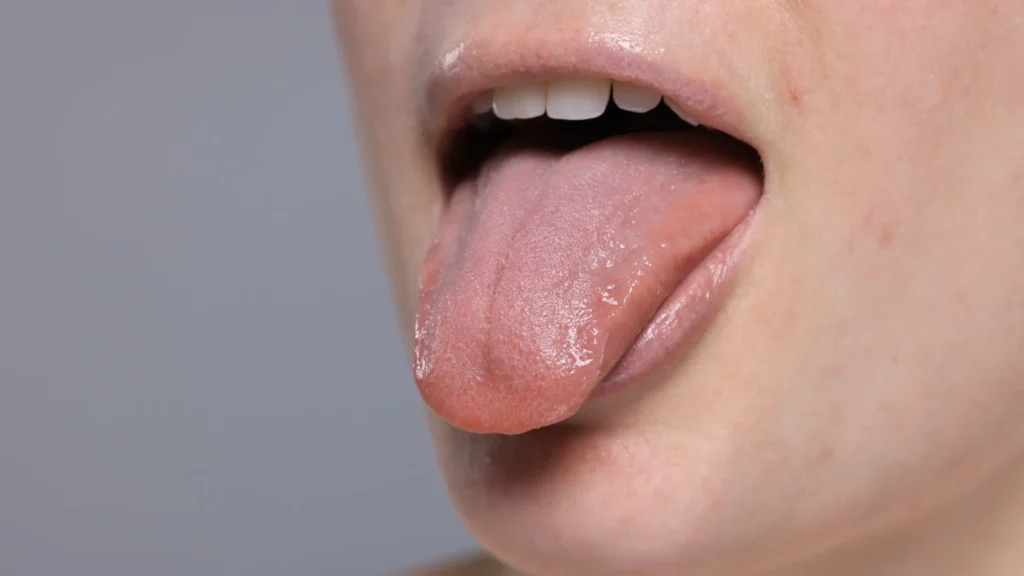 Persona enseñando la lengua para demostrar que tiene la boca seca o sufre de xerostomía