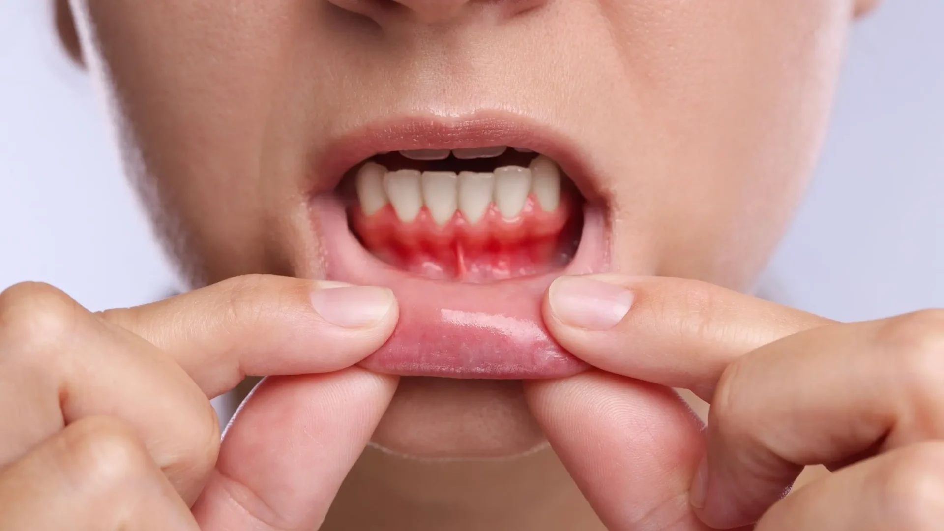 Boca con gingivitis que puede derivar en periodontitis