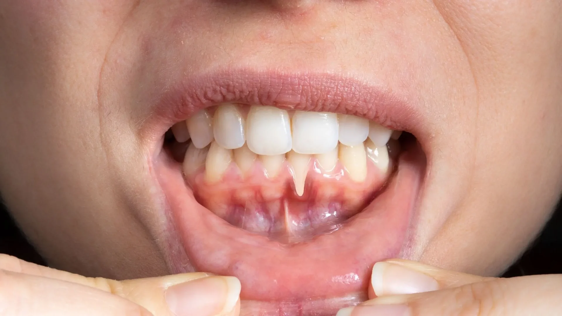 Persona mostrando sus encías que sufren de periodontitis