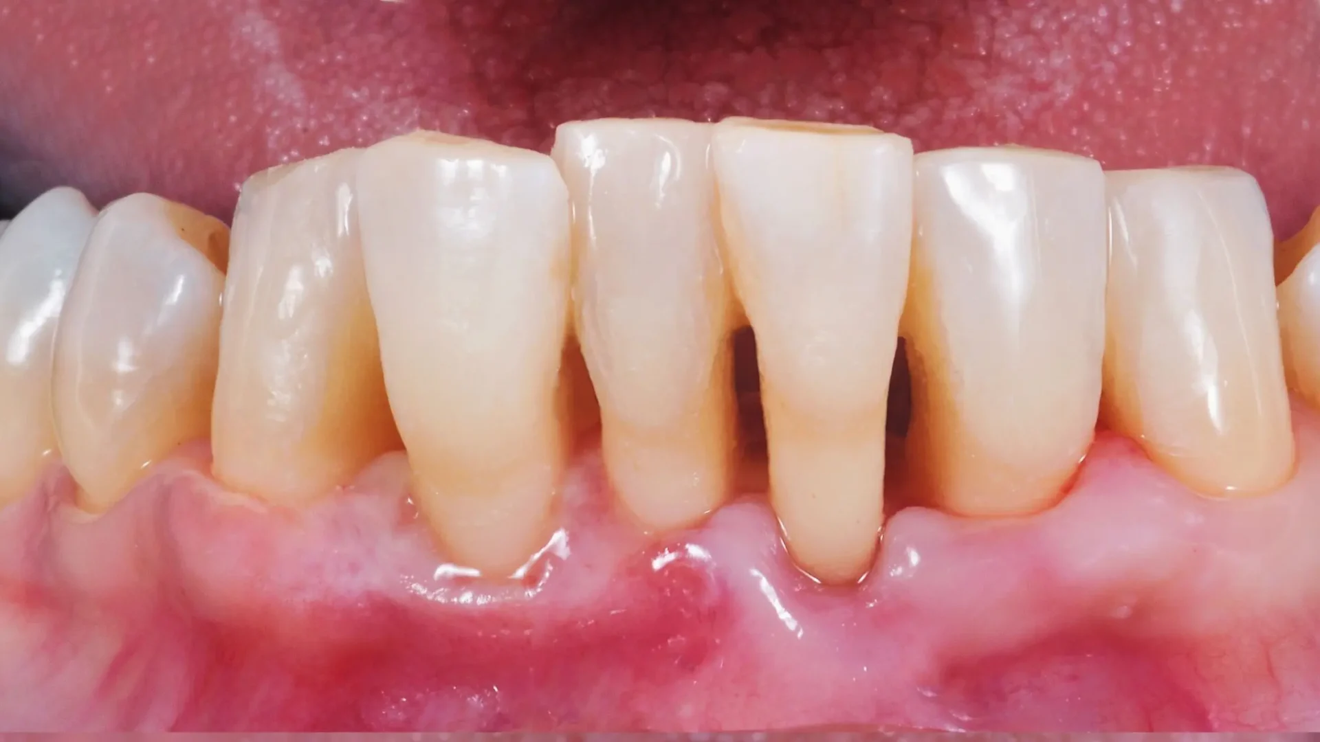 Dientes que sufren de periodontitis