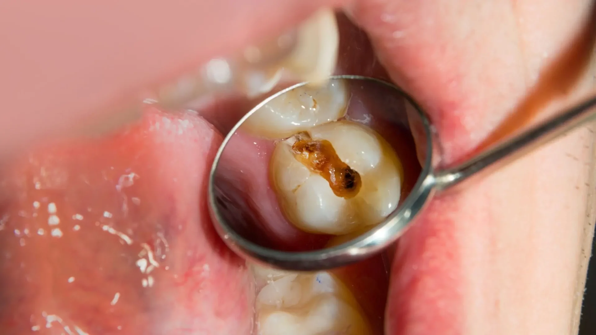 Caries en la boca de un paciente