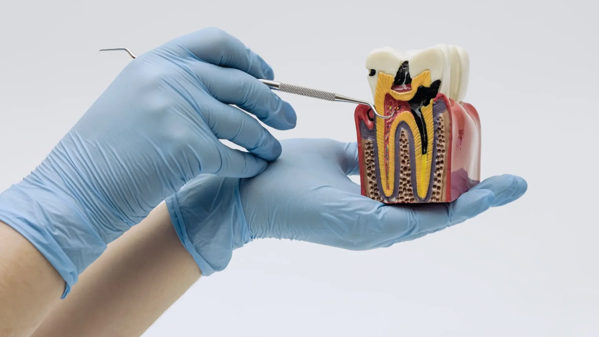 Explicación de cómo es una caries con una maqueta de una dentadura